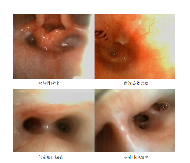 支气管肺炎胸片报告单图片