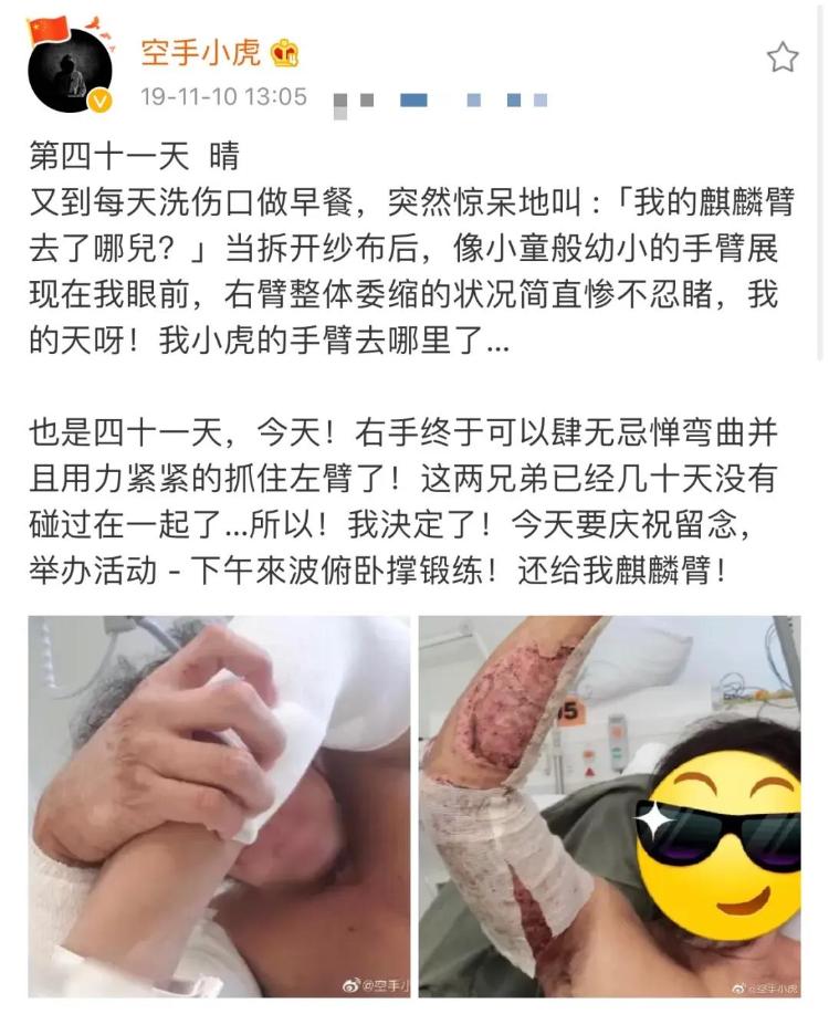 港警“小虎Sir”解开纱布的这幕，太心疼！港警“小虎Sir”解开纱布的这幕，太心疼！