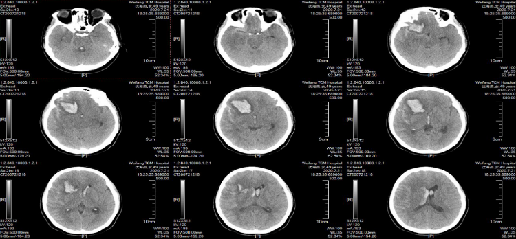 急查颅脑ct显示其右侧额叶(累及基底节区)脑出血破入脑室并蛛网膜下