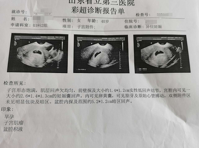 宫外孕检查报告图片图片