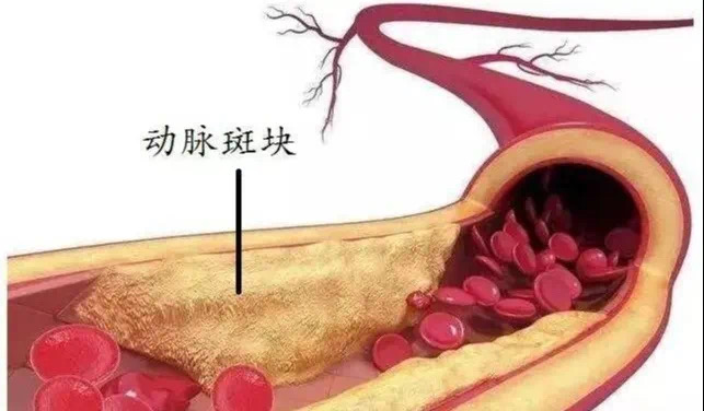 潍坊市中医院斑块旋切技术还原下肢血管自然腔道让血管更通畅