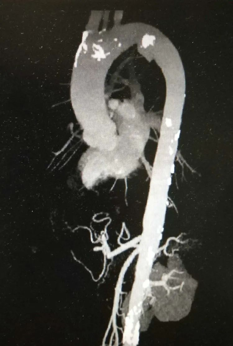 主動脈假性動脈瘤破裂濰坊市中醫院覆膜支架腔內修復術化險為夷