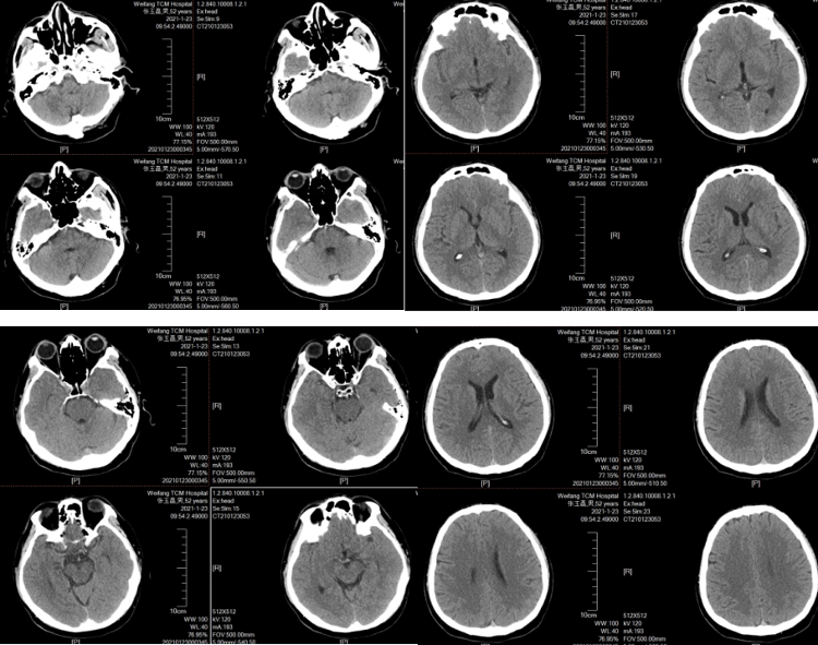 脑瘤报告单图片图片