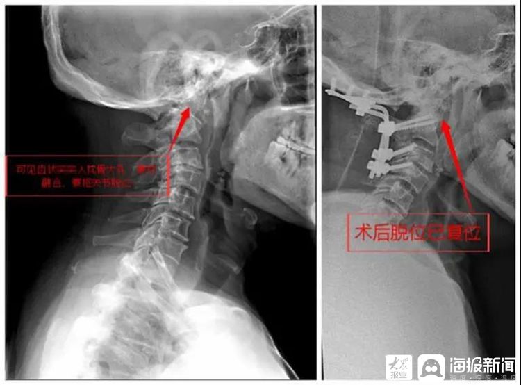 颅底陷入症图片