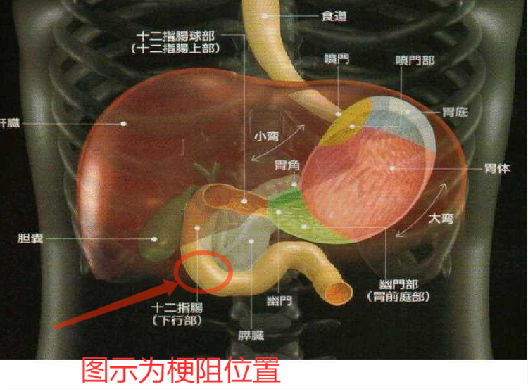 壶腹癌在哪个位置图片图片