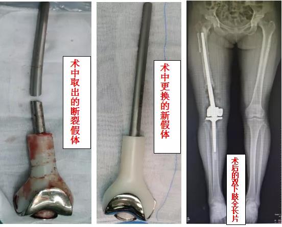 技术硬实力!济宁市第一人民医院成功开展高难度肿瘤膝关节假体翻修术