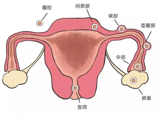 潍坊市人民医院专家提醒:试管婴儿并不能完全避免宫外孕