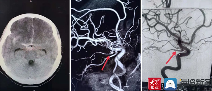 近日,泰安市第一人民医院神经外科成功救治一名颅内动脉瘤破裂出训哪