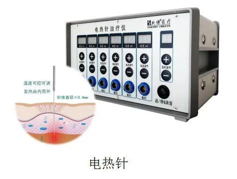 针与灸的完美结合潍坊市中医院治未病中心电热针技术