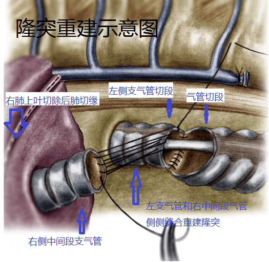 濰坊市第二人民醫院濰坊呼吸病醫院再成功完成一例氣管隆突腫瘤切除右