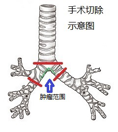 濰坊市第二人民醫院濰坊呼吸病醫院再成功完成一例氣管隆突腫瘤切除右