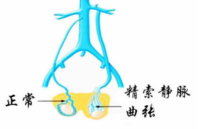 睾丸蚯蚓状图片图片