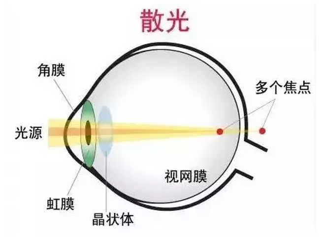 潍坊市人民医院专家为您讲解:孩子散光怎么办?