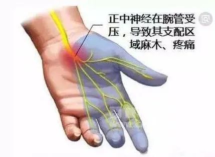 在手腕处正中神经和9条肌腱共同经过由骨骼和韧带构成的骨纤维隧道中