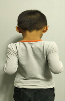 5岁儿童脊柱后凸图片