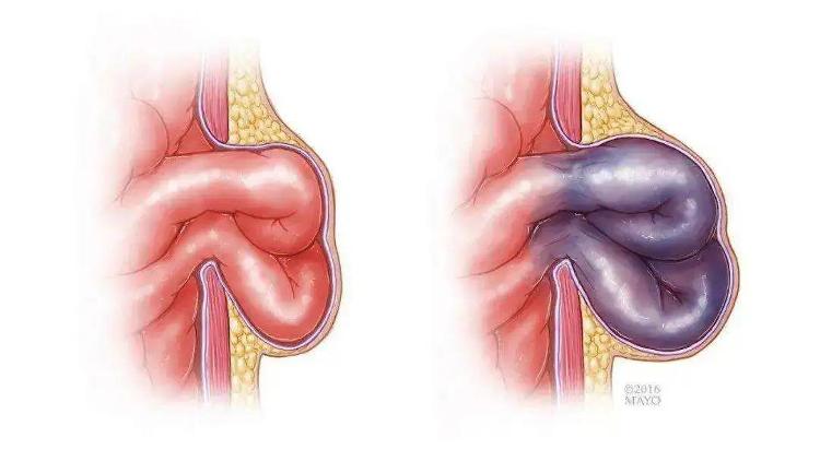 探查见患者腹腔有浑浊渗液,部分回肠自左侧股环疝出并嵌顿, 出现肠