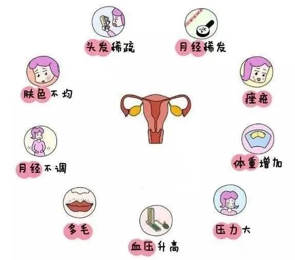 潍坊市人民医院专家为您讲解什么是多囊卵巢综合征