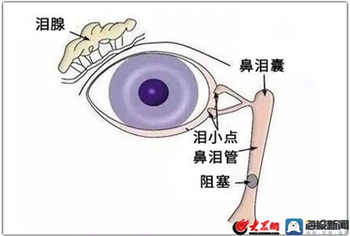 爱美大姐整日泪水涟涟原来是泪道阻塞了