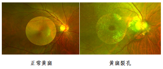 黄斑裂孔险致盲尽早手术是关键