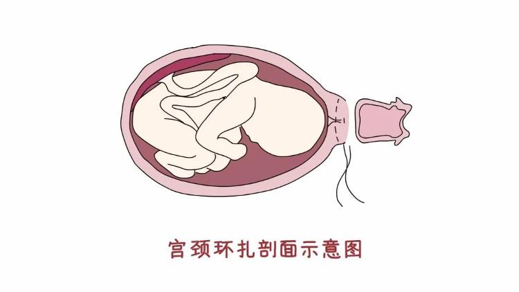 紧急宫颈环扎术图片