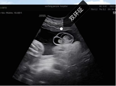 五个月男宝睾丸彩超图图片
