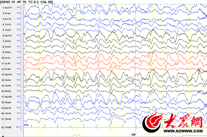 脑电图报告单图片