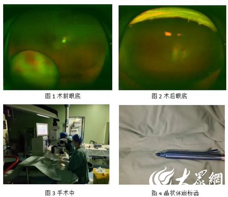 棗莊市中醫醫院完成首例晶狀體玻璃體腔內超聲粉碎聯合人工晶體鞏膜層