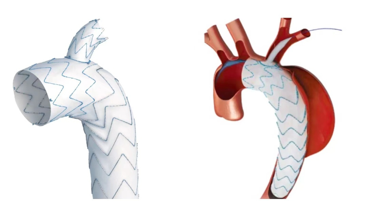 主动脉覆膜支架图片图片