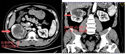 “极限拆弹”！阳光融和医院泌尿泛亚电竞外科韩修武团队完成超高