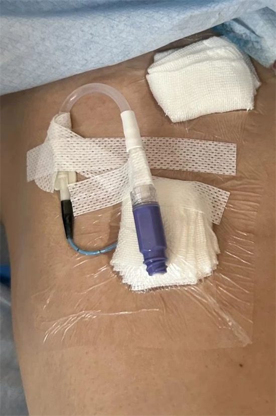 潍坊市第二人民医院隧道式下肢静脉picc置管技术为患者构筑生命通道