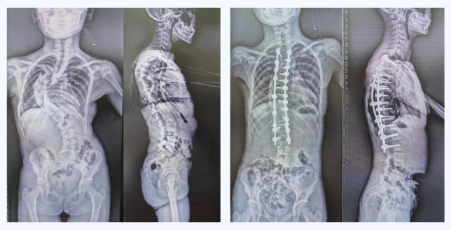 脊柱侧弯达87度青岛市海慈医疗集团脊柱矫形术让s形少女长高6公分