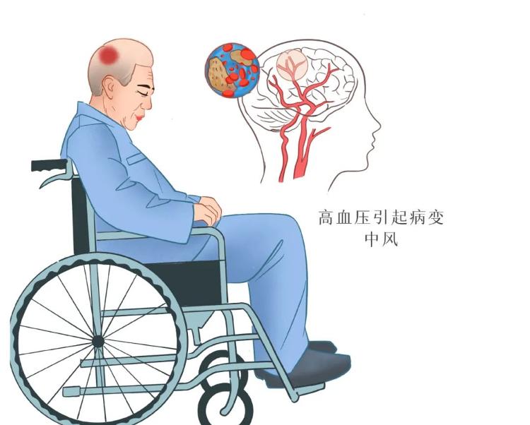 脑梗死患者如需接受高压氧治疗，需要注意什么