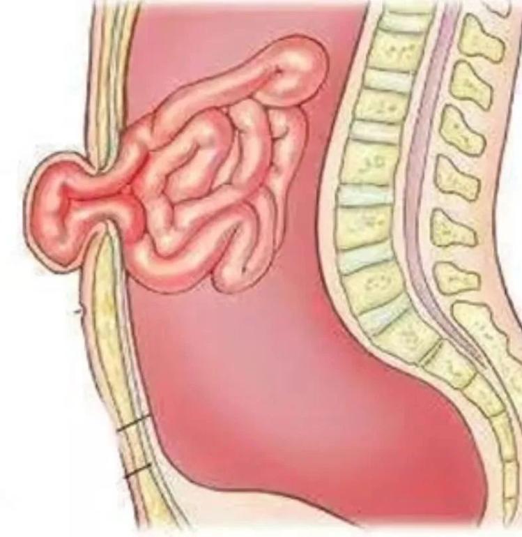 小儿腹白线疝图片