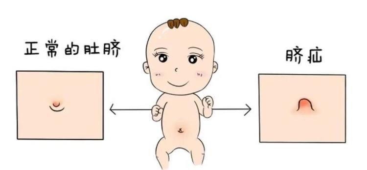 婴幼儿正常肚脐图片图片