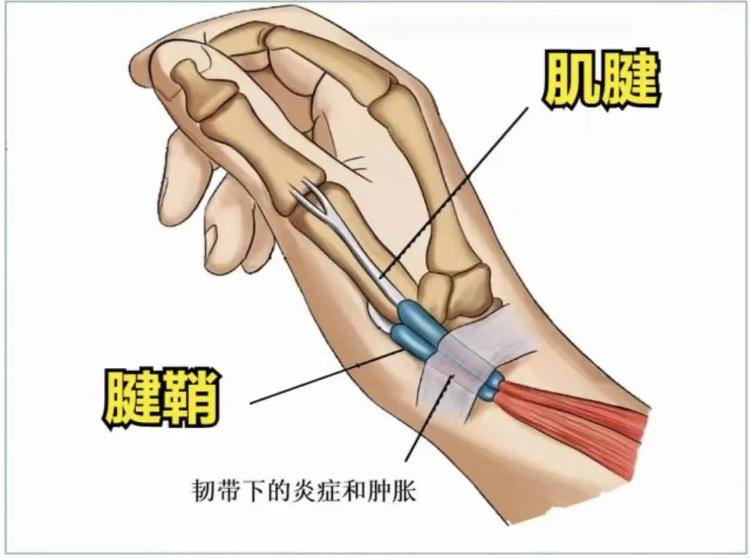 手腕痛手指痛看这里一招解决妈妈手