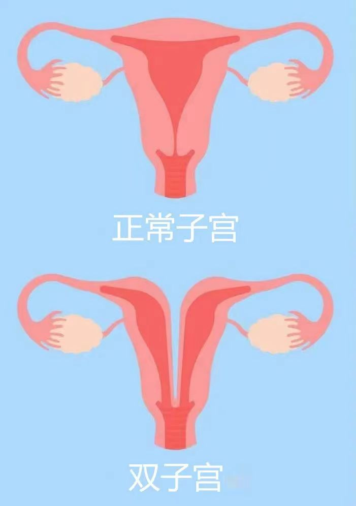 畸形双子宫双宫颈图片图片