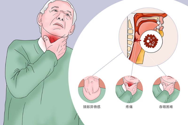 咽喉癌位置图片图片
