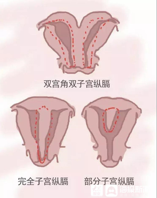 纵膈子宫的B超图片图片