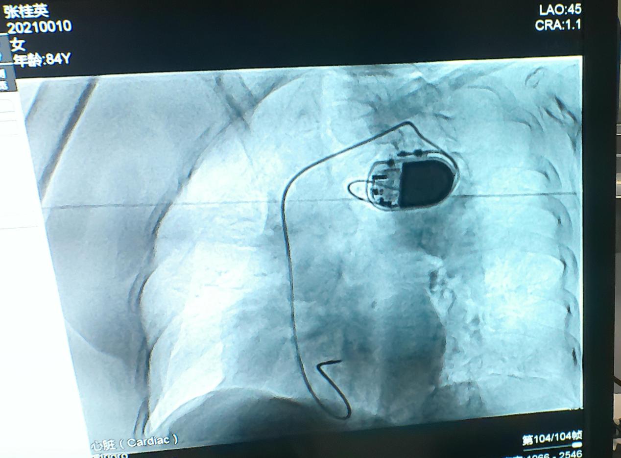 臨沂凱旋醫院介入科心臟起搏器安裝手術成功完成