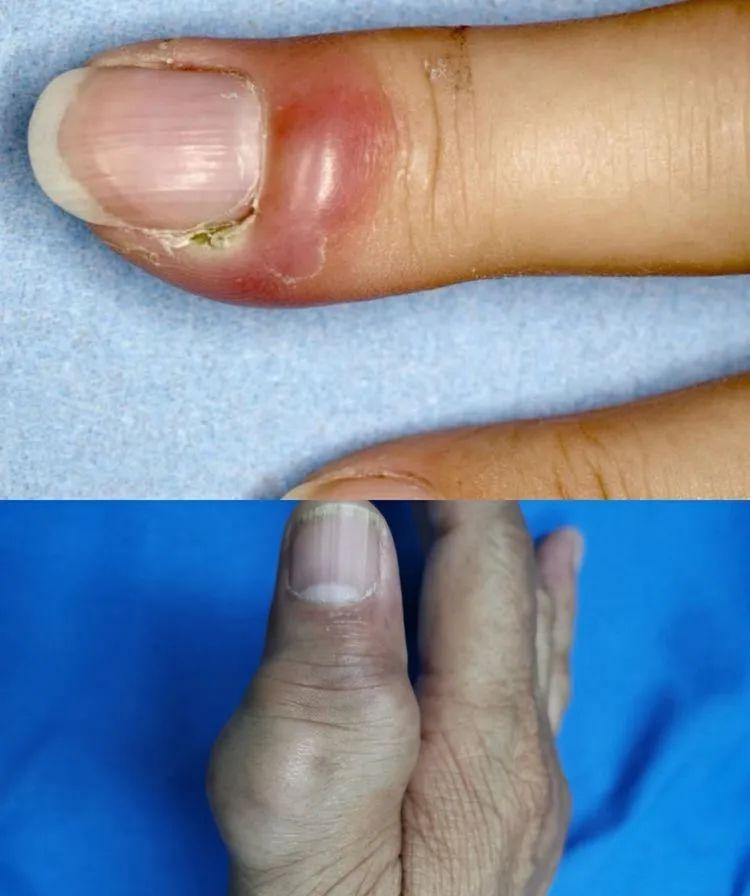 手指骨膜炎的症状图片图片