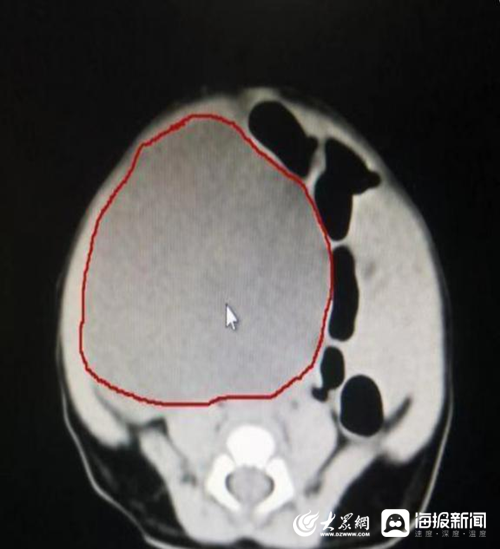 卵巢囊肿检查单子图片图片