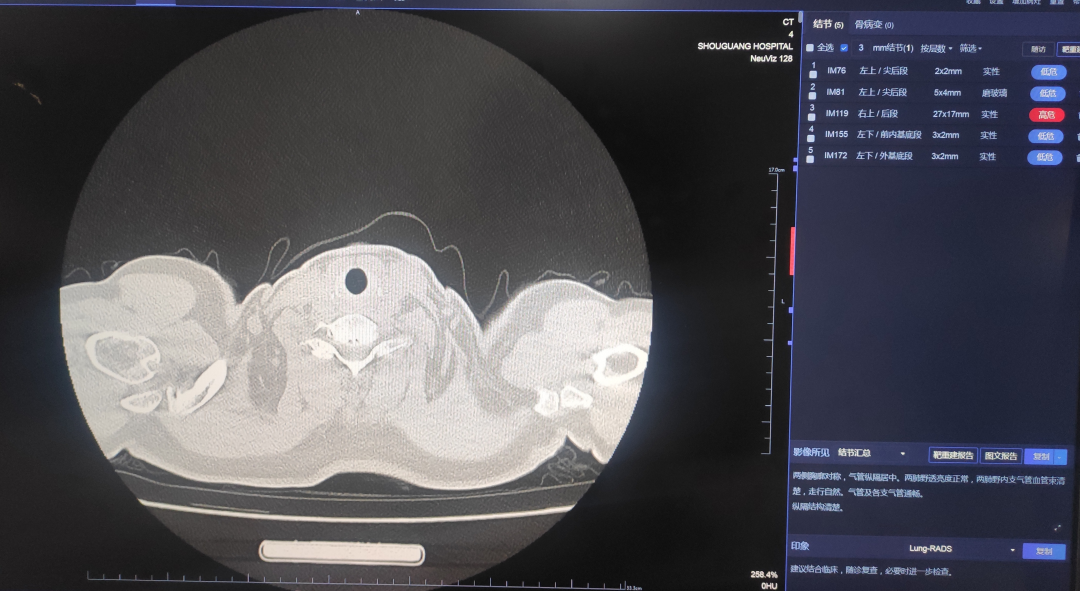 医学前沿丨寿光综合医院引进AI肺结节分析软件，让肺结节无处可藏