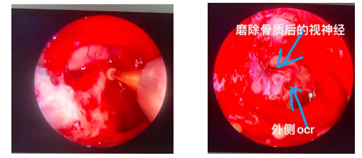 经鼻救眼？原来鼻孔微创可以进行视神经管减压术