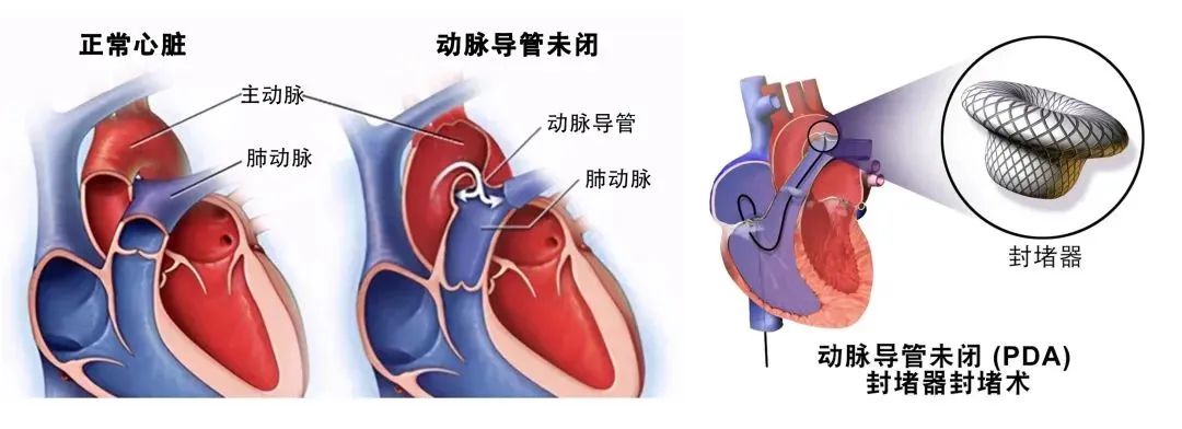 动脉导管未闭手术图片