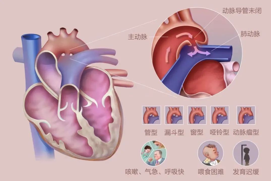 动脉导管未闭手术图片