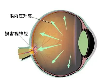 华德眼科：了解青光眼，警惕这个隐匿的“视力杀手”