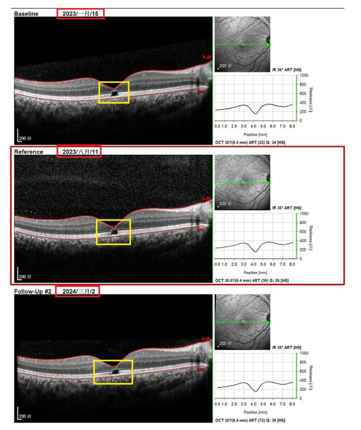 oct黄斑厚度图正常范围图片